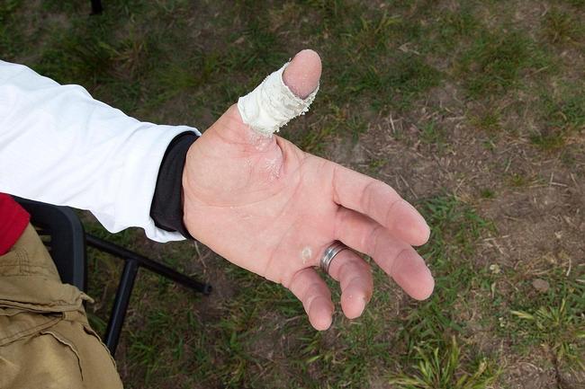 Jason Lambert shows off the tape job on his thumb, which has been inflicted with a bad case of 